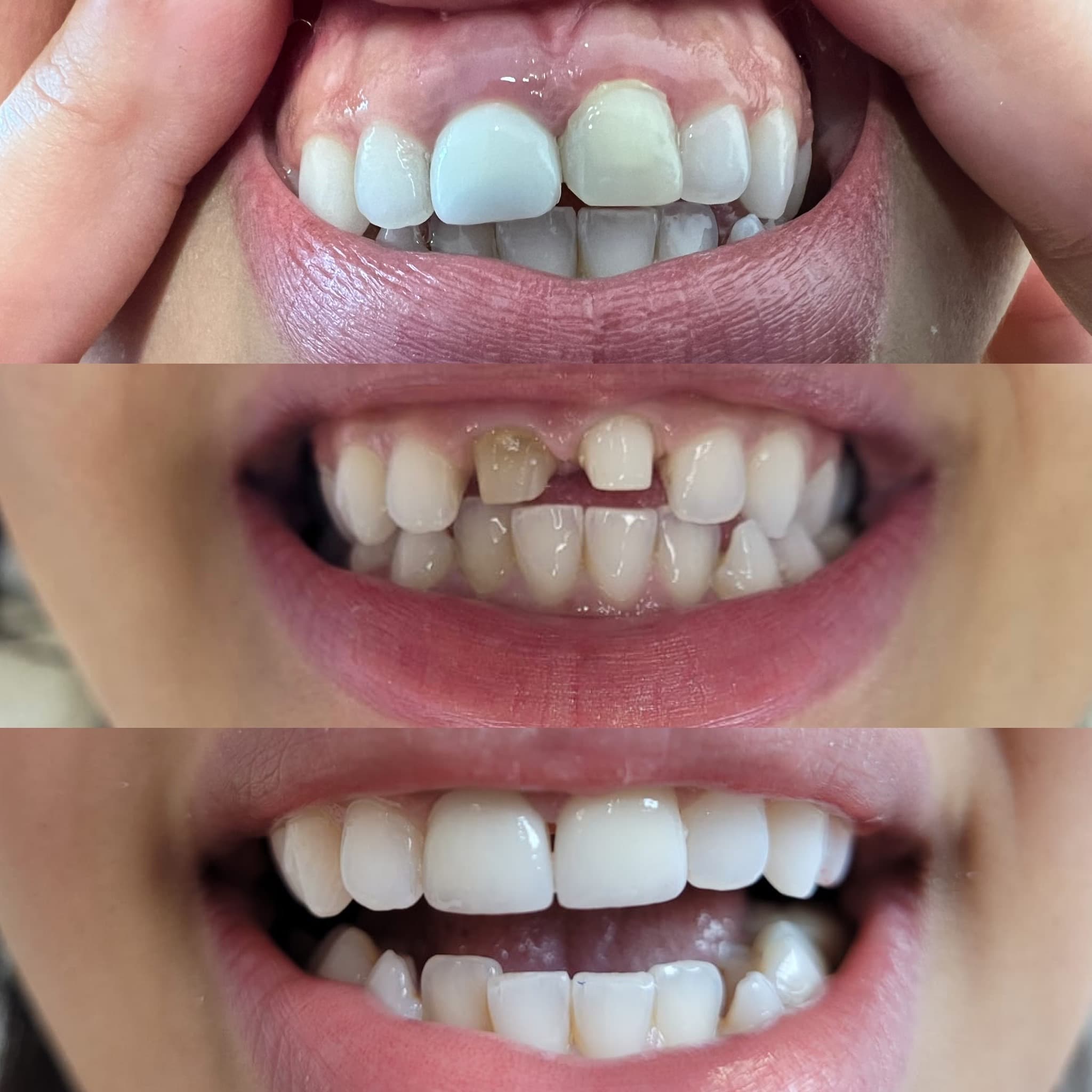 Couronne conjointe full EMAX réalisée au laboratoire